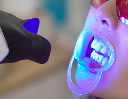 Teeth Whitening in Riyadh
