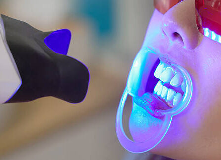 Teeth Whitening in Riyadh