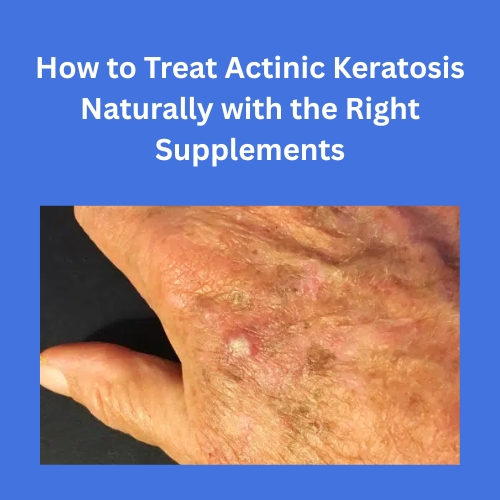 How to Treat Actinic Keratosis Naturally