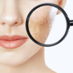 Laser Acne Scar Treatment in Riyadh