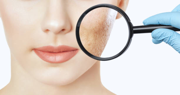 Laser Acne Scar Treatment in Riyadh