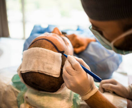 Hair transplant in Dubai