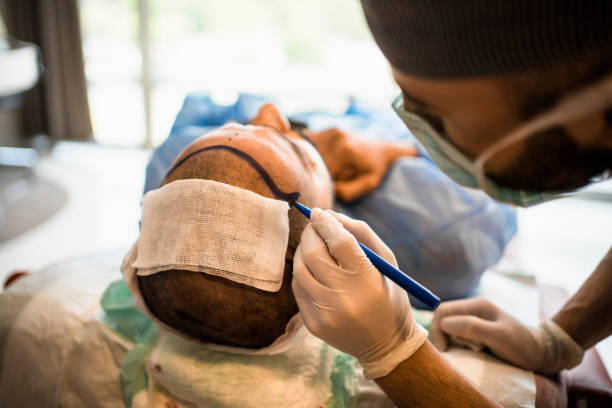 Hair transplant in Dubai