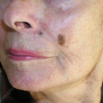 Natural Seborrheic Keratosis Remedies and safe treatment options for common skin growths