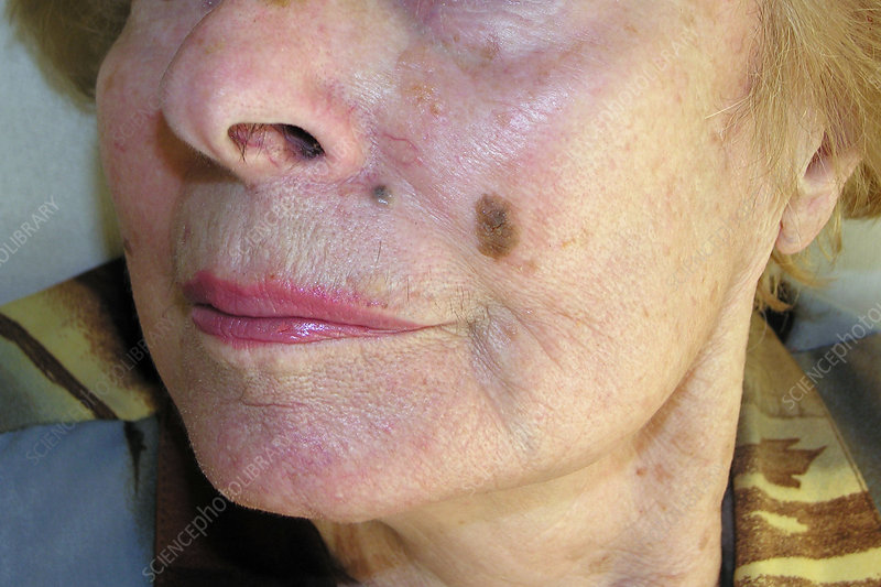 Natural Seborrheic Keratosis Remedies and safe treatment options for common skin growths